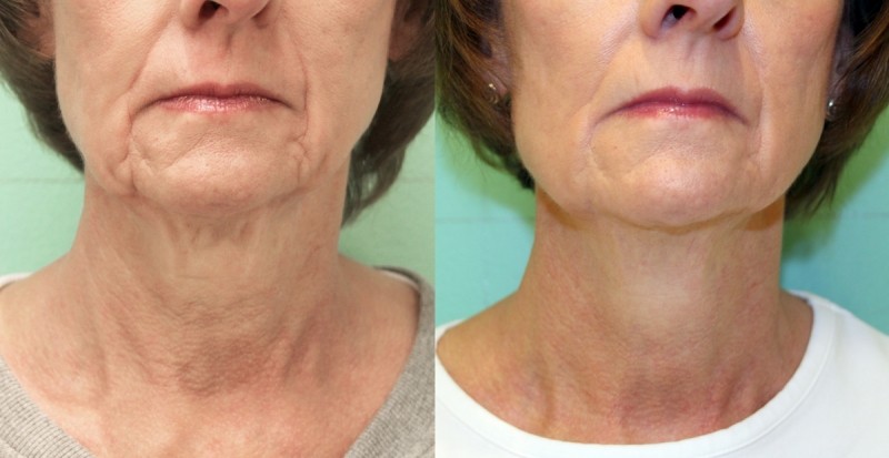 exilis ultra avant après bouche