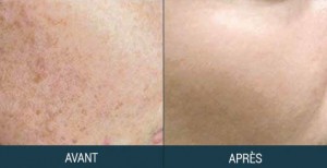 photorajeunissement paramedical avant-après