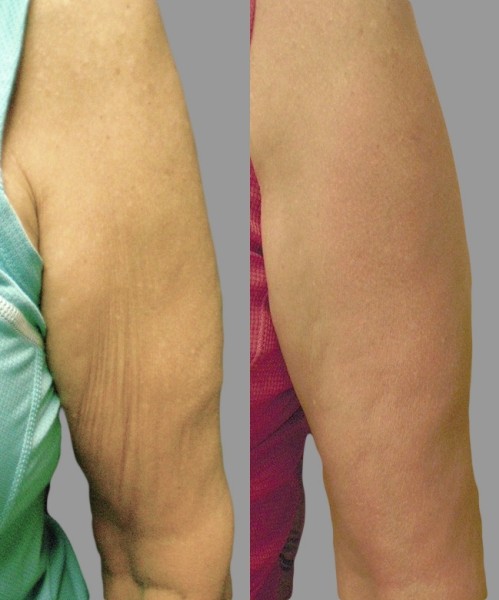 exilis ultra avant après bras