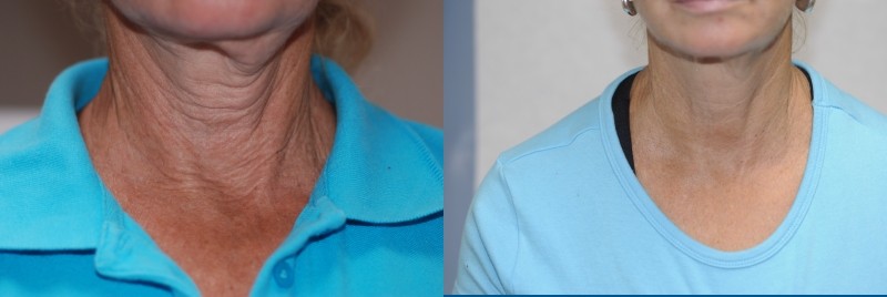 exilis ultra avant après coup