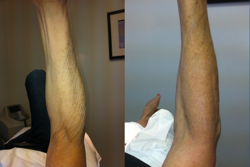 exilis ultra avant après avant-bras