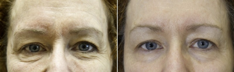 exilis ultra avant après front