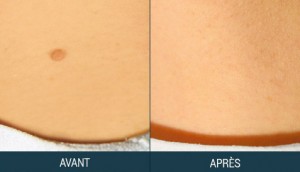 thermocoagulation croûtelles avant après